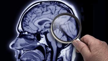Científicos hallan una forma de retrasar el Alzheimer a través de la creación de un "reloj genético"