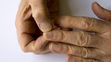 Piden realizar el test de 5 segundos con las uñas para detectar el cáncer que suma nuevos casos sin parar en España